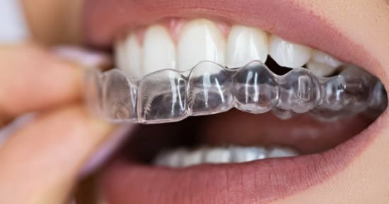 Invisalign
